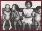 Indonesian Children Suffering from Kwashiorkor